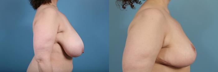 Before & After Breast Reduction Case 129 View #3 View in Chicago, IL