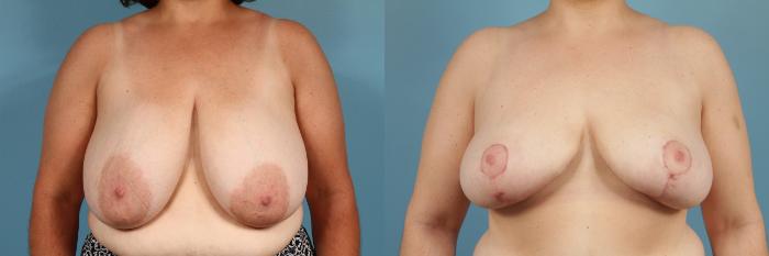 Before & After Breast Reduction Case 130 View #1 View in Chicago, IL