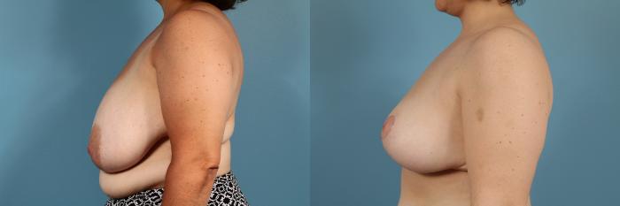 Before & After Breast Reduction Case 130 View #2 View in Chicago, IL