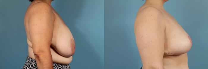 Before & After Breast Reduction Case 130 View #3 View in Chicago, IL