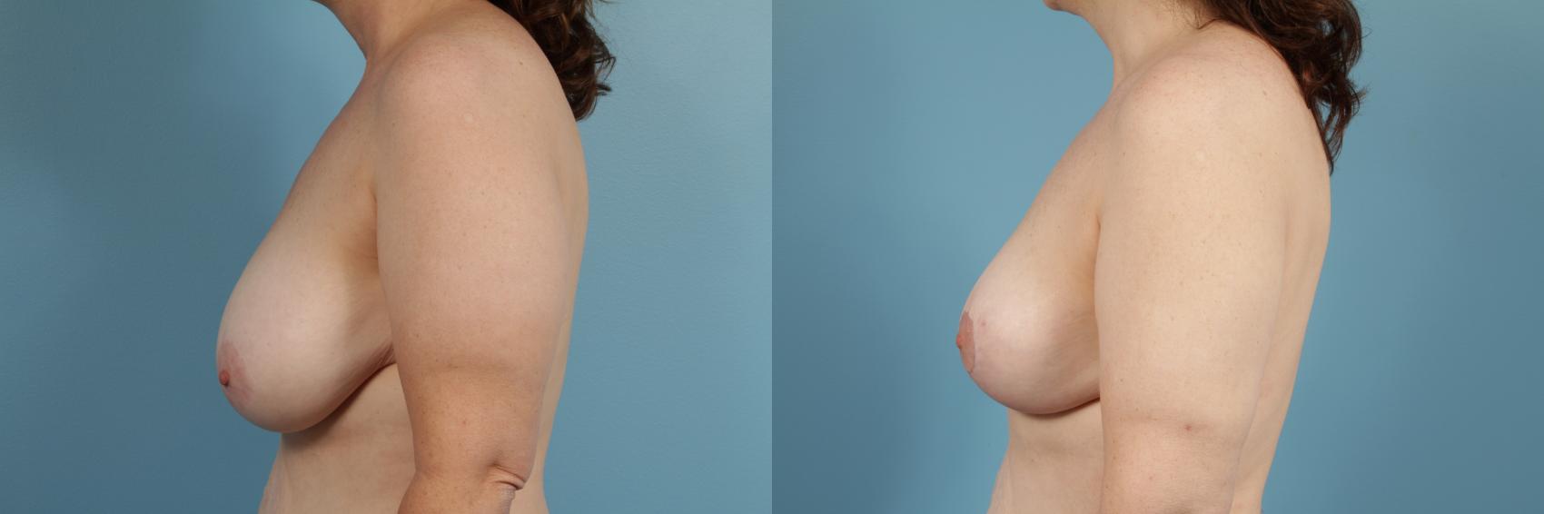 Before & After Breast Reduction Case 132 View #2 View in Chicago, IL