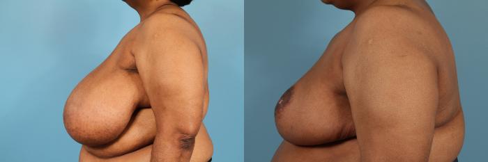 Before & After Breast Reduction Case 135 View #2 View in Chicago, IL