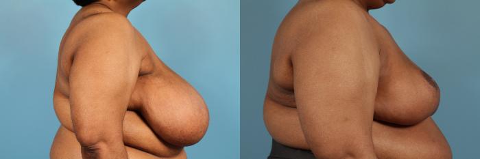 Before & After Breast Reduction Case 135 View #3 View in Chicago, IL