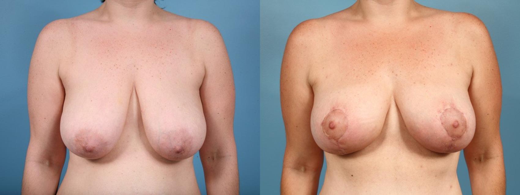 Before & After Breast Reduction Case 14 View #1 View in Chicago, IL
