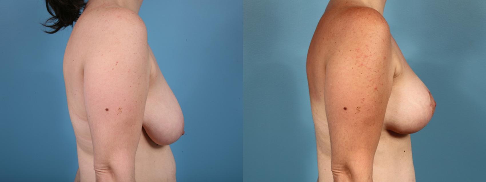 Before & After Breast Reduction Case 14 View #2 View in Chicago, IL