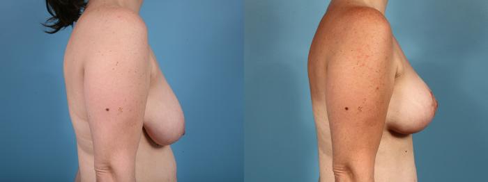 Before & After Breast Reduction Case 14 View #2 View in Chicago, IL