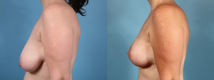 Before & After Breast Reduction Case 14 View #3 View in Chicago, IL