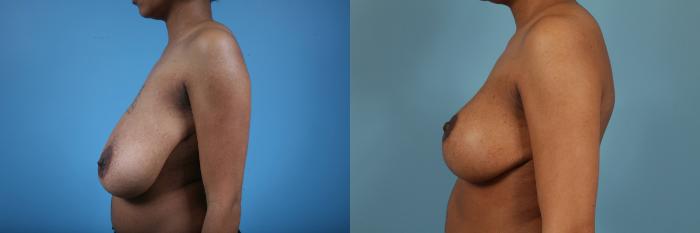 Before & After Breast Reduction Case 146 View #1 View in Chicago, IL