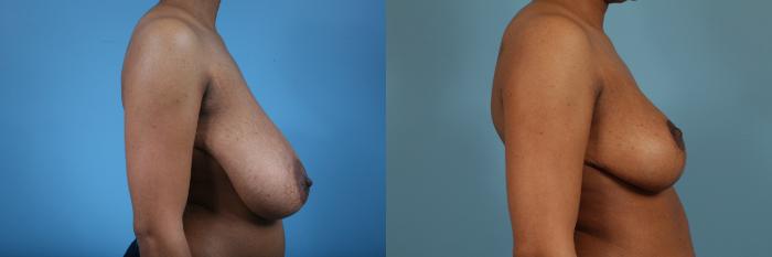 Before & After Breast Reduction Case 146 View #3 View in Chicago, IL