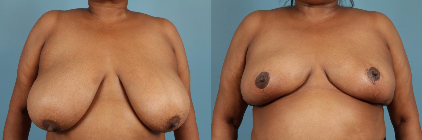 Before & After Breast Reduction Case 157 View #1 View in Chicago, IL