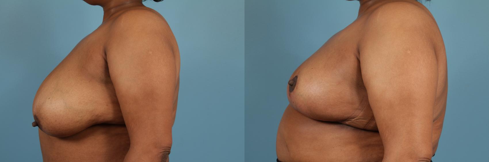Before & After Breast Reduction Case 157 View #2 View in Chicago, IL