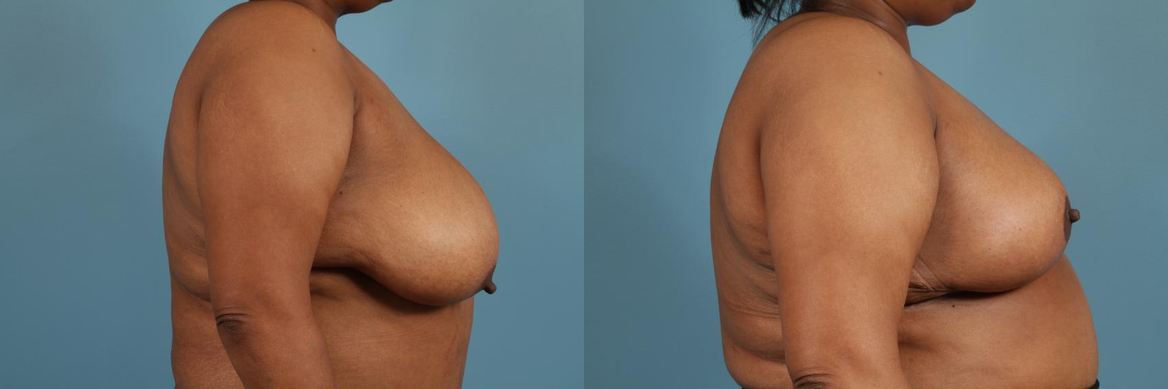 Before & After Breast Reduction Case 157 View #3 View in Chicago, IL