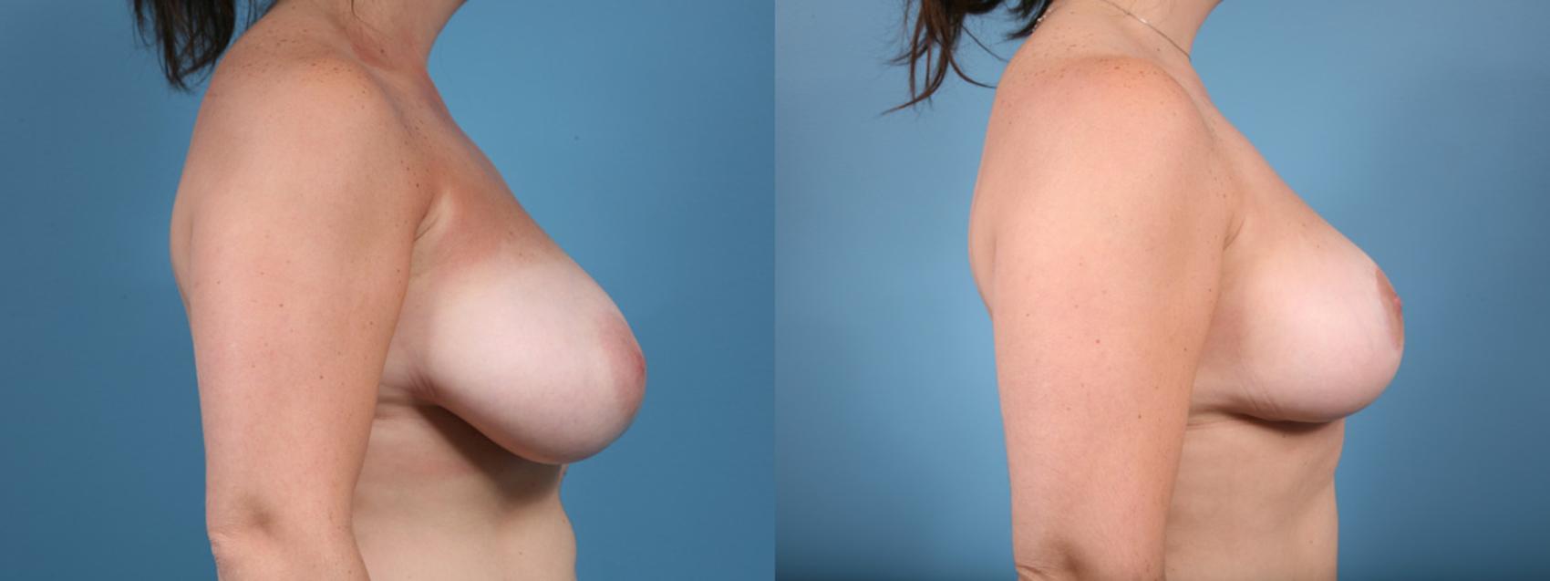 Before & After Breast Reduction Case 17 View #2 View in Chicago, IL