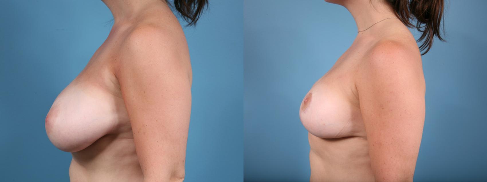 Before & After Breast Reduction Case 17 View #3 View in Chicago, IL