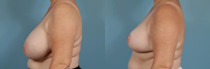 Before & After Breast Reduction Case 173 View #2 View in Chicago, IL