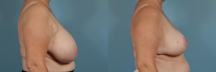 Before & After Breast Reduction Case 173 View #3 View in Chicago, IL