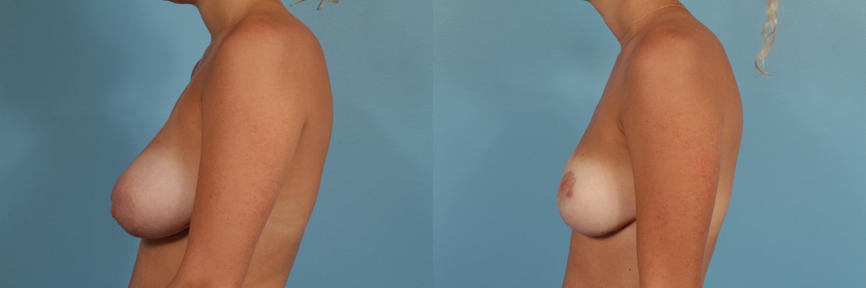 Before & After Breast Reduction Case 178 View #2 View in Chicago, IL