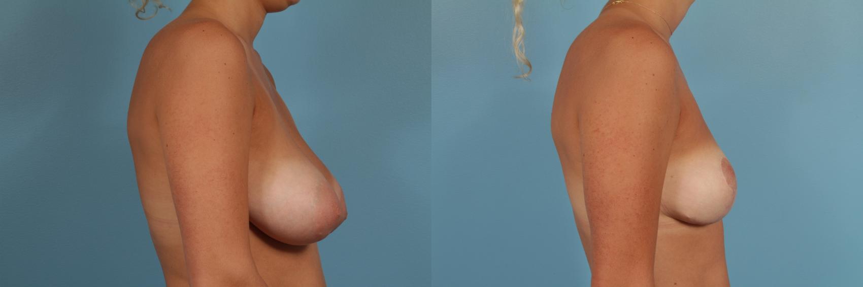 Before & After Breast Reduction Case 178 View #3 View in Chicago, IL