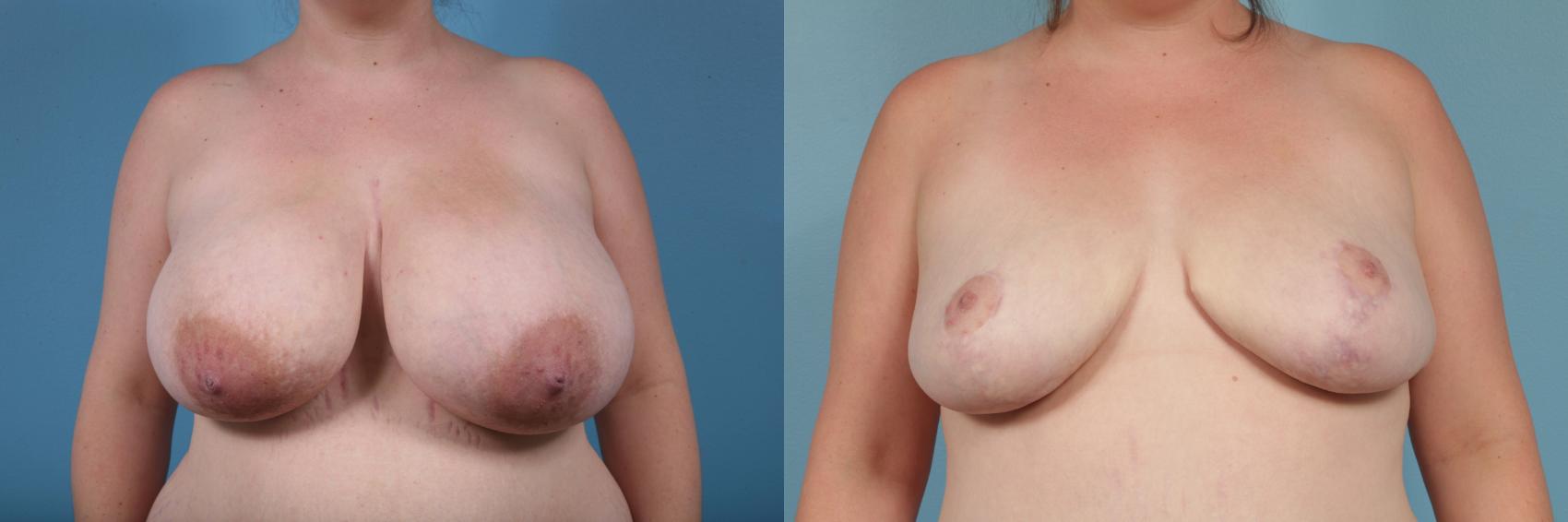 Before & After Breast Reduction Case 180 View #1 View in Chicago, IL