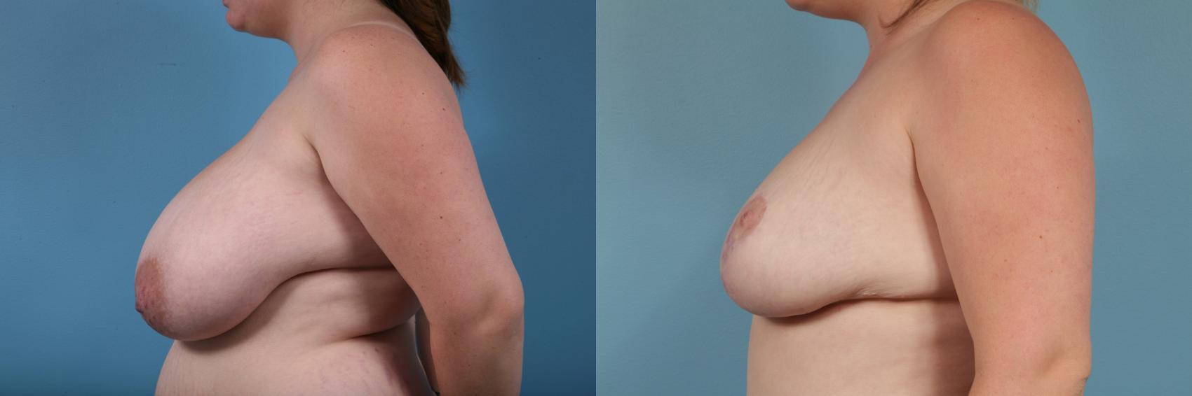 Before & After Breast Reduction Case 180 View #2 View in Chicago, IL