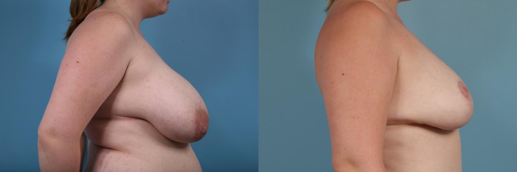 Before & After Breast Reduction Case 180 View #3 View in Chicago, IL