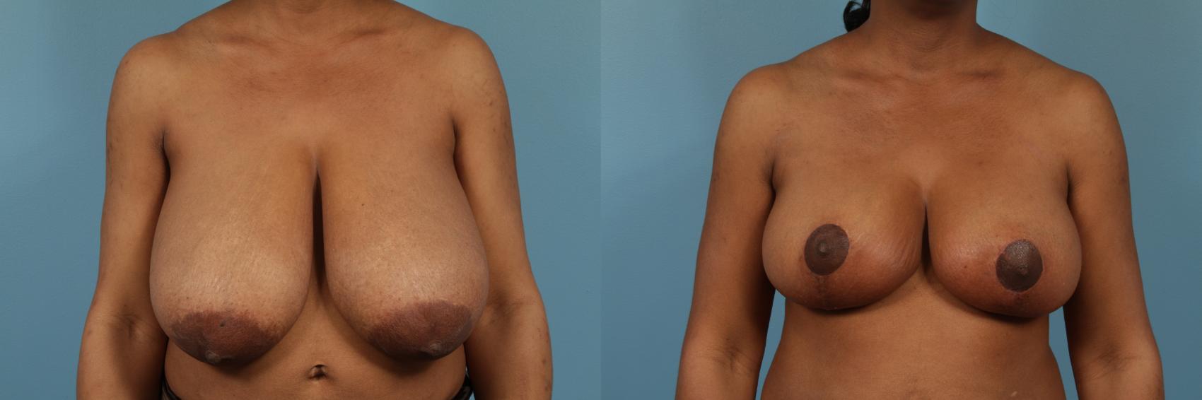Before & After Breast Reduction Case 190 View #1 View in Chicago, IL