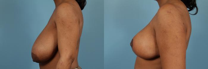 Before & After Breast Reduction Case 190 View #2 View in Chicago, IL