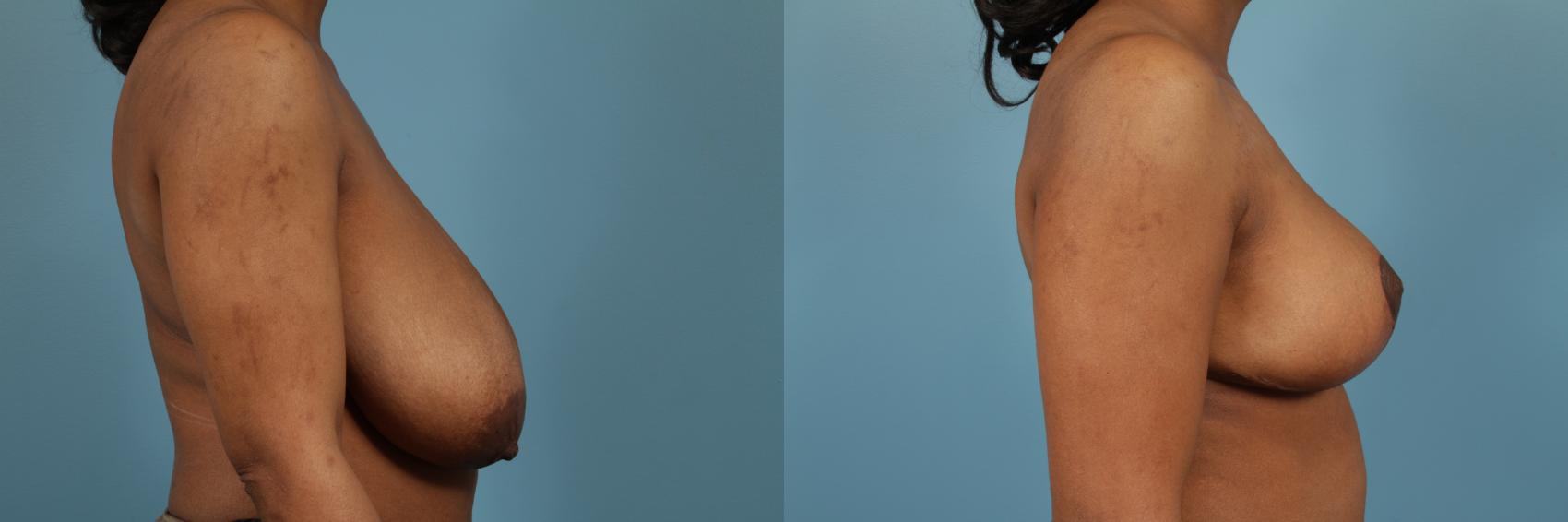 Before & After Breast Reduction Case 190 View #3 View in Chicago, IL