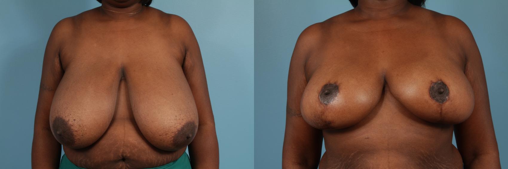 Before & After Breast Reduction Case 191 View #1 View in Chicago, IL