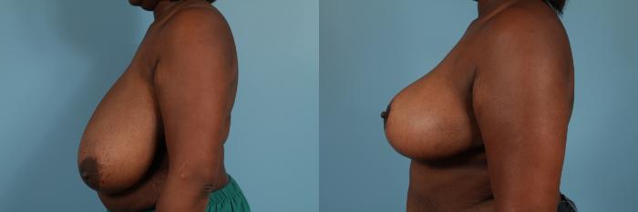 Before & After Breast Reduction Case 191 View #2 View in Chicago, IL