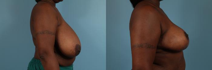 Before & After Breast Reduction Case 191 View #3 View in Chicago, IL