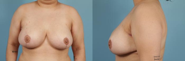 Before & After Breast Reduction Case 201 View #2 View in Chicago, IL