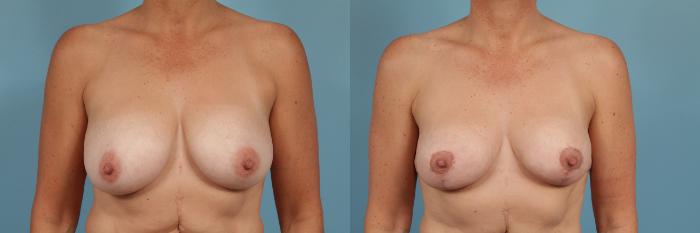 Before & After Breast Reduction Case 206 View #1 View in Chicago, IL