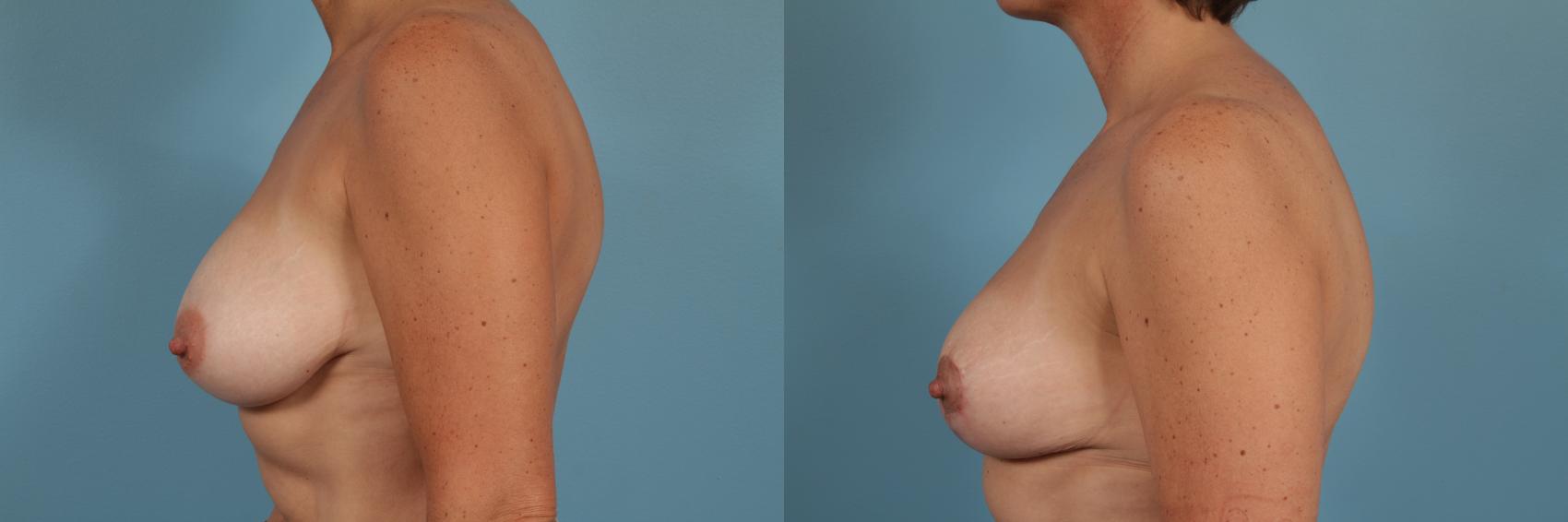 Before & After Breast Reduction Case 206 View #2 View in Chicago, IL