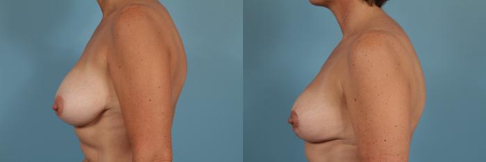 Before & After Breast Reduction Case 206 View #2 View in Chicago, IL