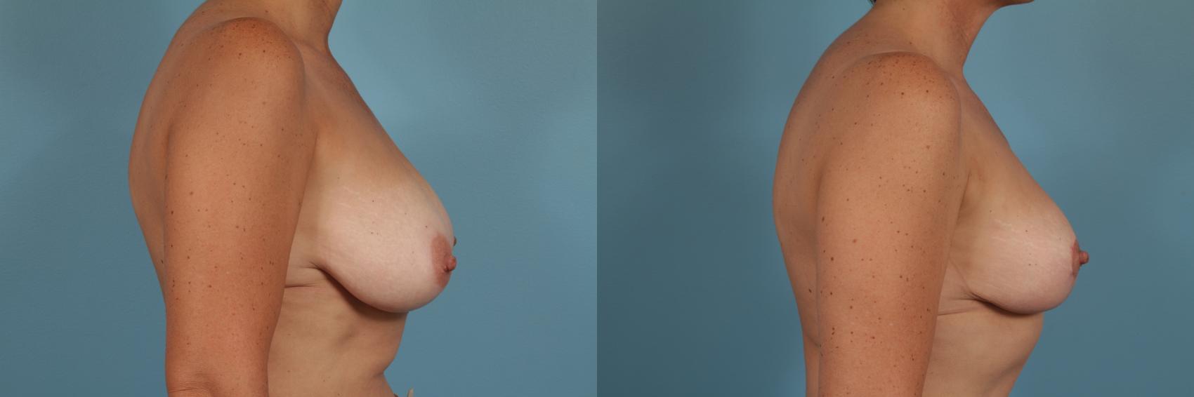 Before & After Breast Reduction Case 206 View #3 View in Chicago, IL