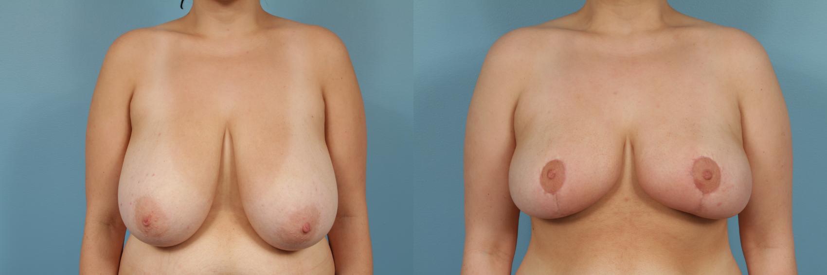 Before & After Breast Reduction Case 217 View #1 View in Chicago, IL