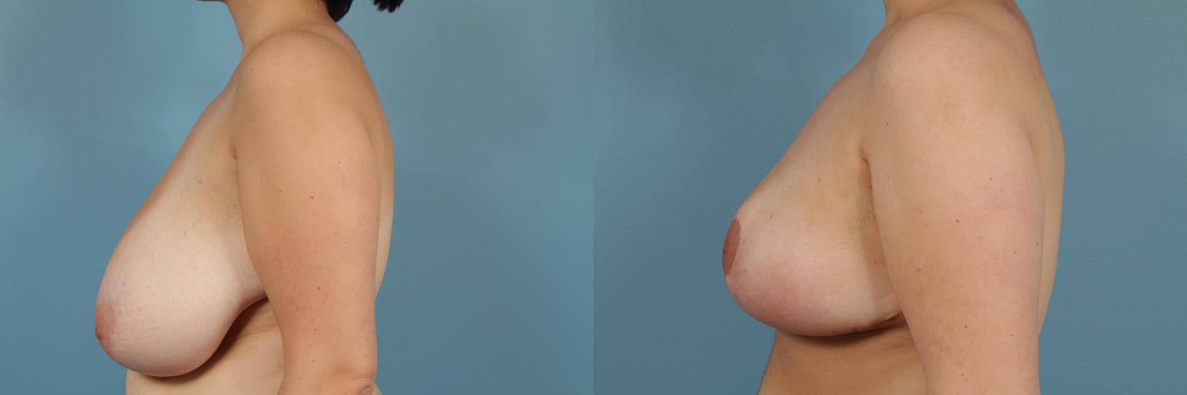 Before & After Breast Reduction Case 217 View #2 View in Chicago, IL