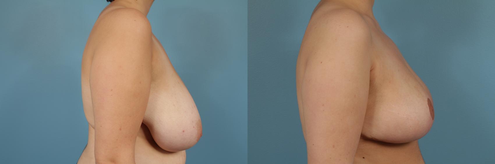 Before & After Breast Reduction Case 217 View #3 View in Chicago, IL