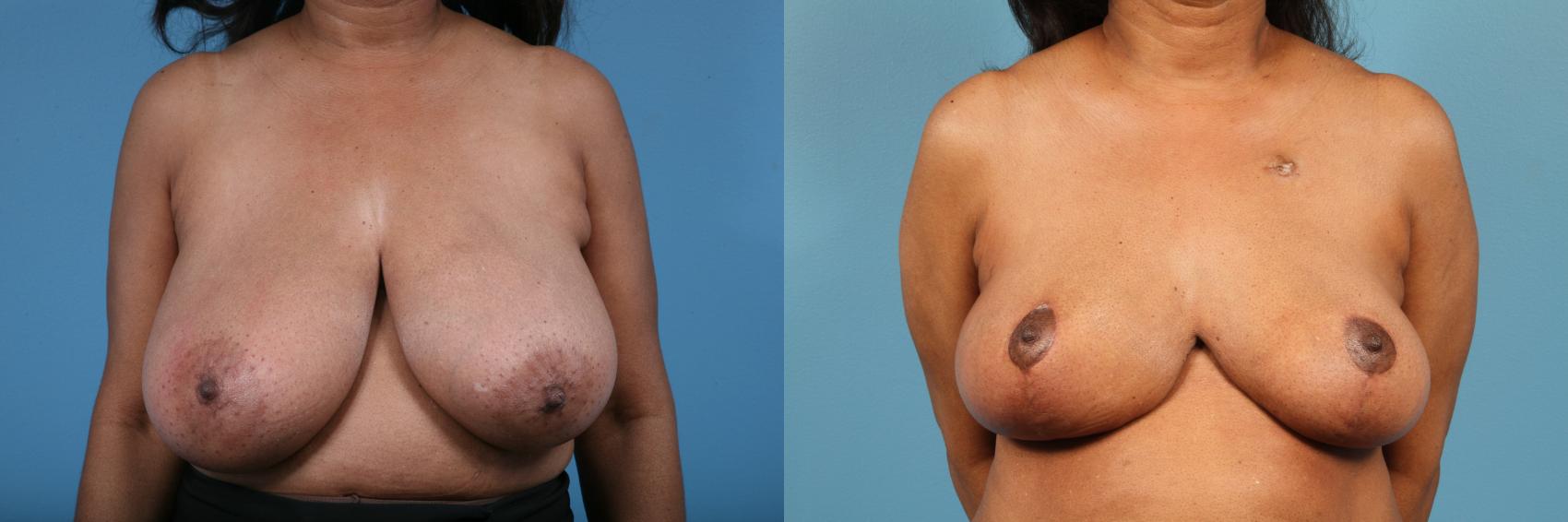Before & After Breast Reduction Case 220 View #1 View in Chicago, IL