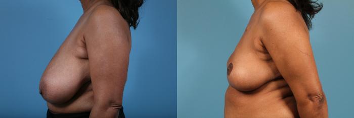Before & After Breast Reduction Case 220 View #2 View in Chicago, IL