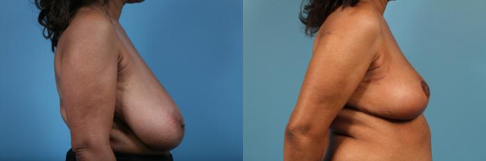 Before & After Breast Reduction Case 220 View #3 View in Chicago, IL