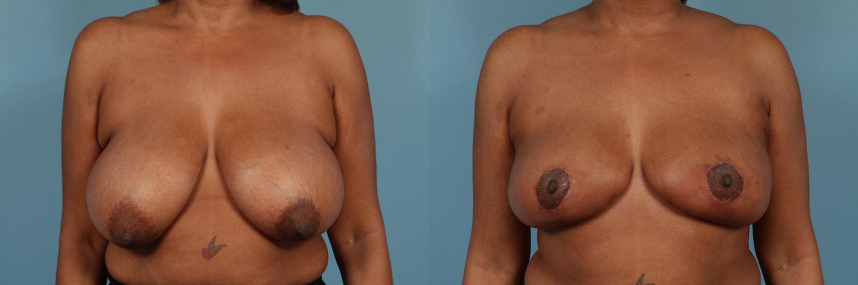 Breast Reduction Case 224 Before & After View #1 | Chicago, IL | TLKM Plastic Surgery
