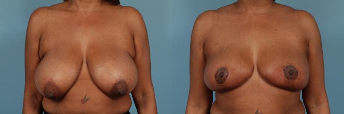 Before & After Breast Reduction Case 224 View #1 View in Chicago, IL
