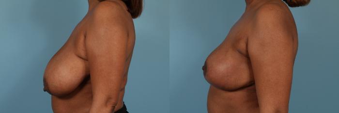 Before & After Breast Reduction Case 224 View #2 View in Chicago, IL