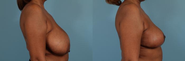 Before & After Breast Reduction Case 224 View #3 View in Chicago, IL