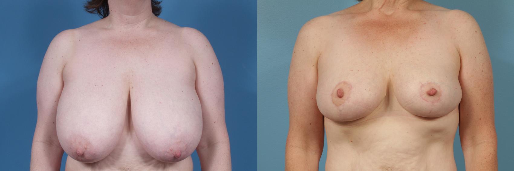 Before & After Breast Reduction Case 226 View #1 View in Chicago, IL