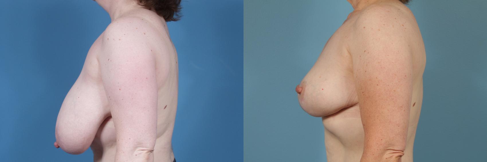 Before & After Breast Reduction Case 226 View #2 View in Chicago, IL