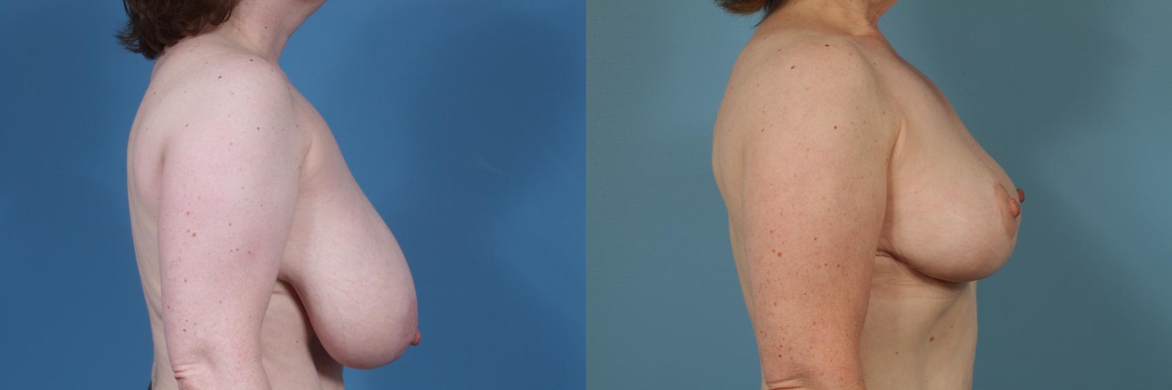 Before & After Breast Reduction Case 226 View #3 View in Chicago, IL