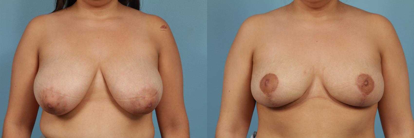 Before & After Breast Reduction Case 233 View #1 View in Chicago, IL